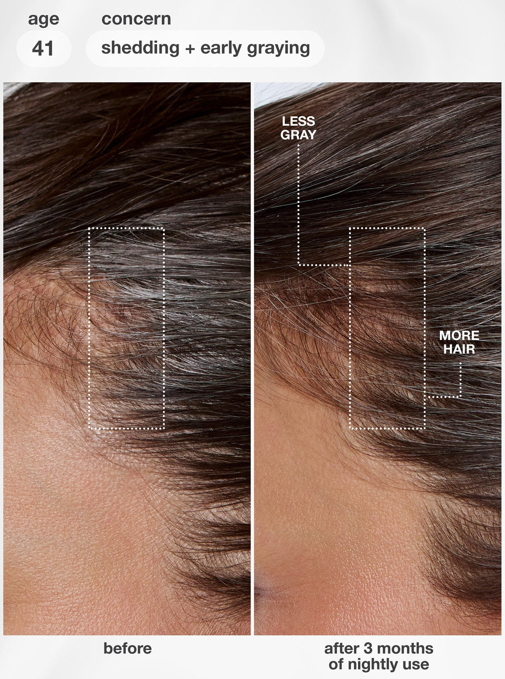 K18 FutureIQ clinical before-and-after results for hair shedding and premature graying