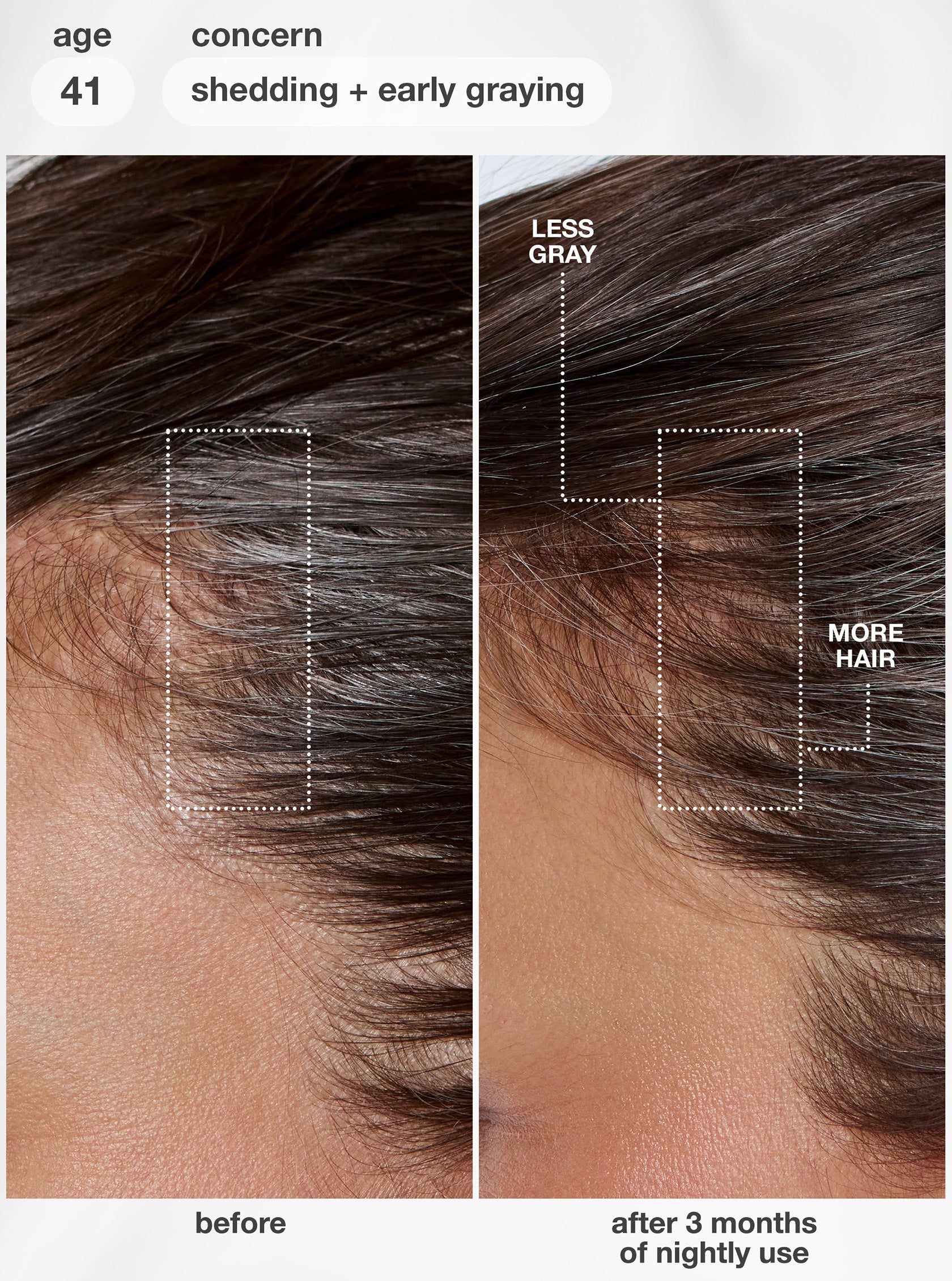 K18 FutureIQ clinical before-and-after results for hair shedding and premature graying